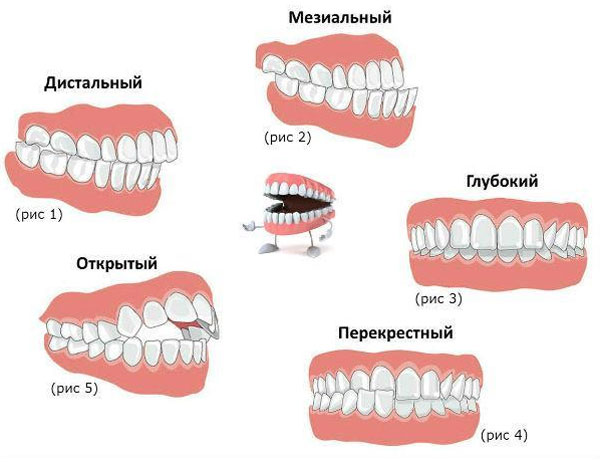 Виды неправильных прикусов