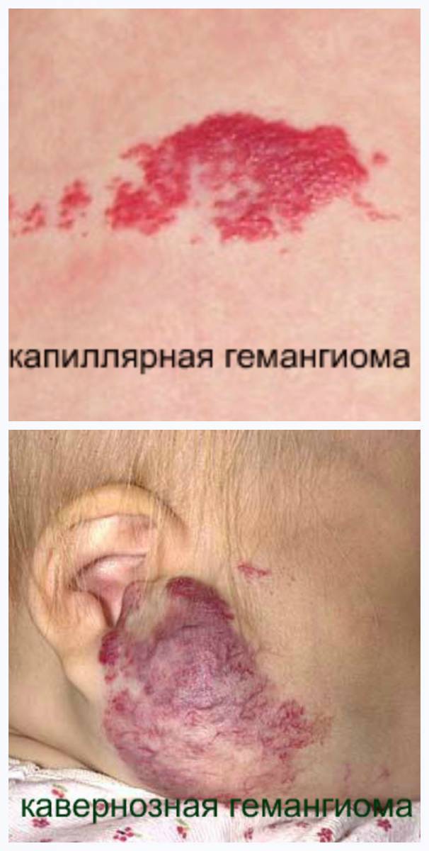 Капиллярная и кавернозная гемангиомы