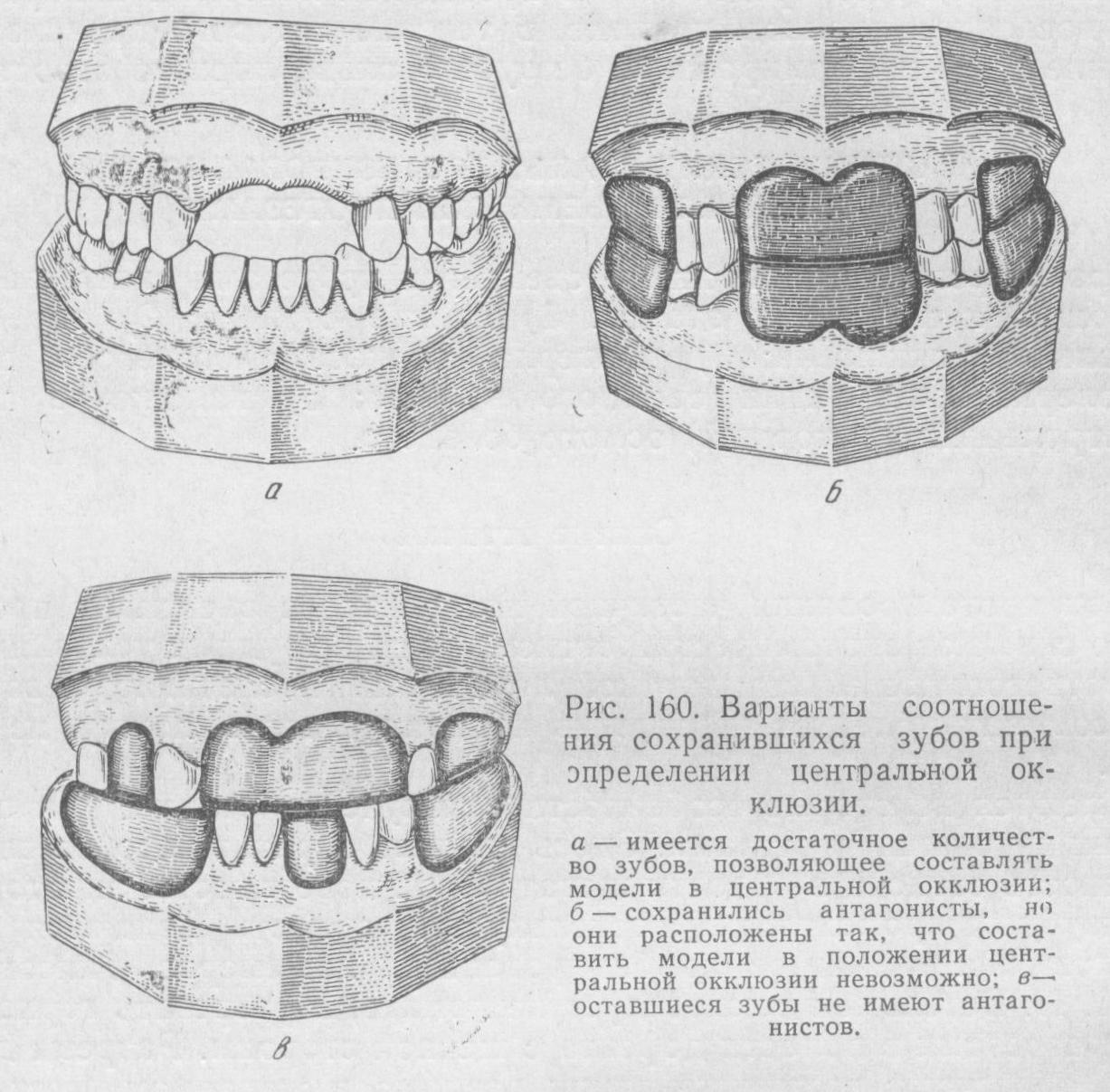 Варианты соотношения сохранившихся зубов при определении центральной окклюзии
