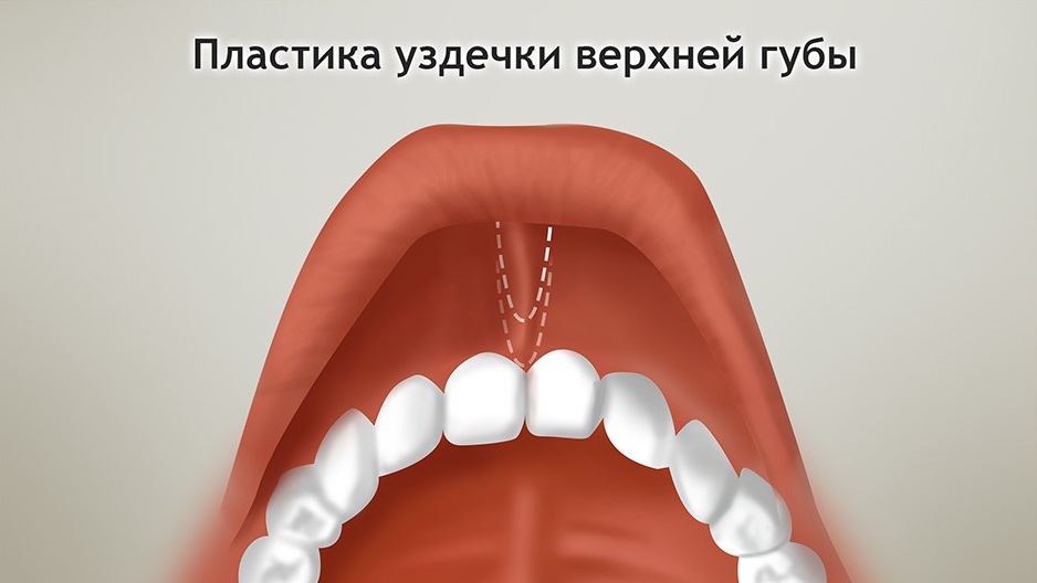 Пластика уздечки