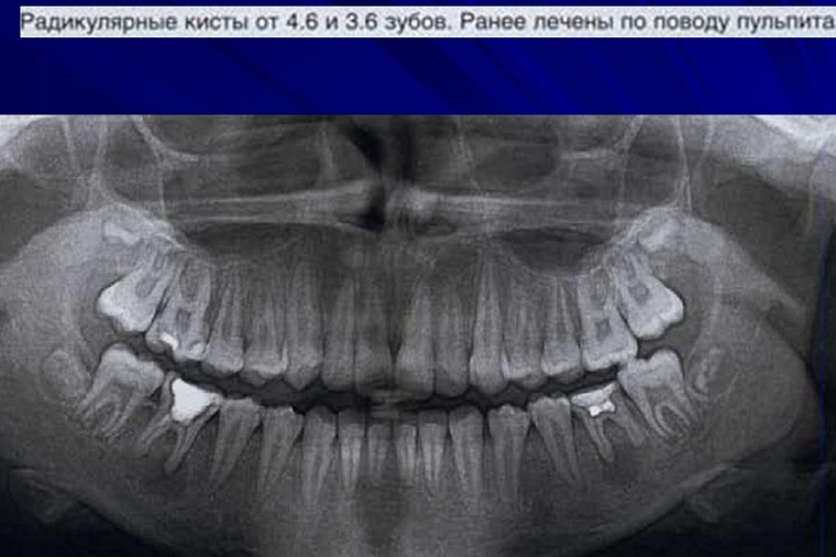 Кисты зуба