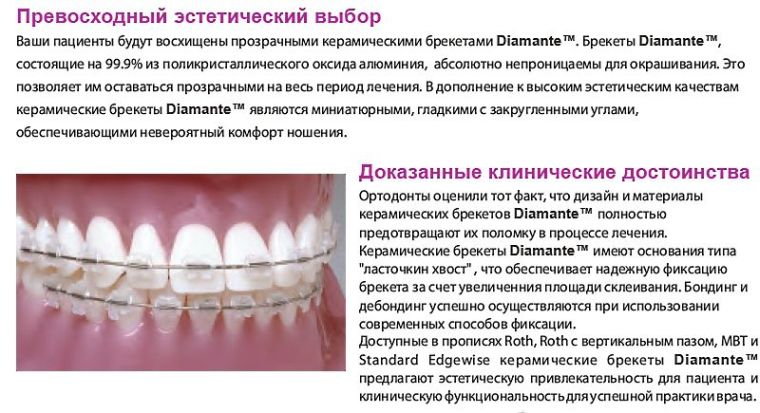Diamante брекеты