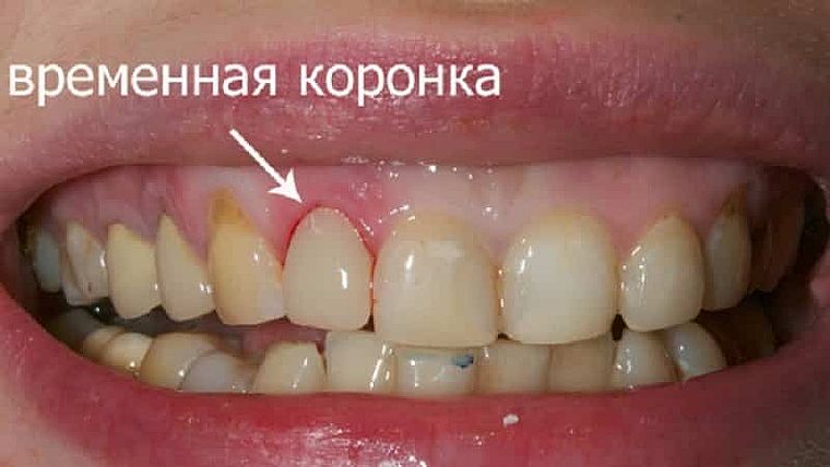 как выглядит временная коронка