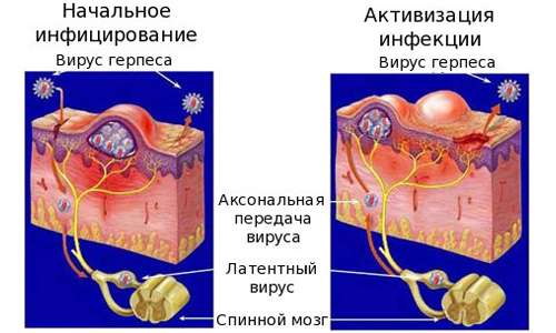 Начальное инфицирование и активизация инфекции