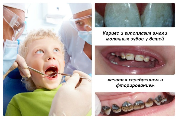 серебрение фторирование молочных зубов