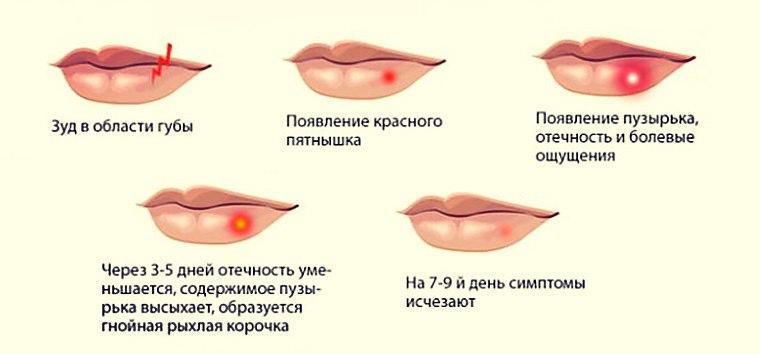 Стадии герпеса