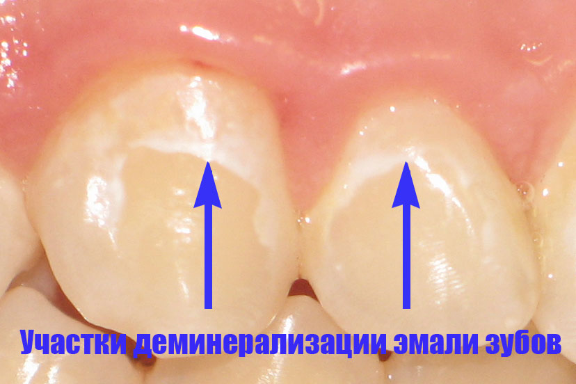 Деминерализация эмали