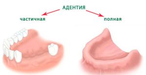 адентия