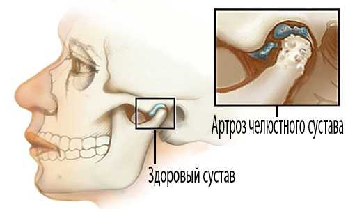 Сустав при артрозе