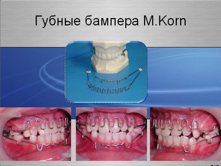 Губной бампер Корна