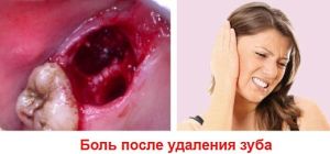 боль после удаления зубов