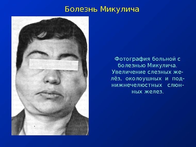 болезнь микулича