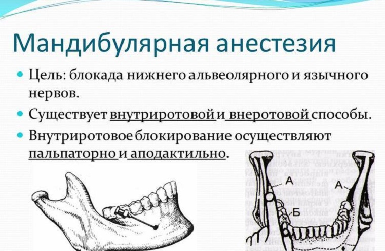 мандибулярная анестезия