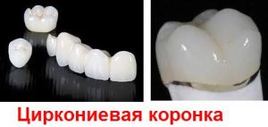 Циркониевая коронка