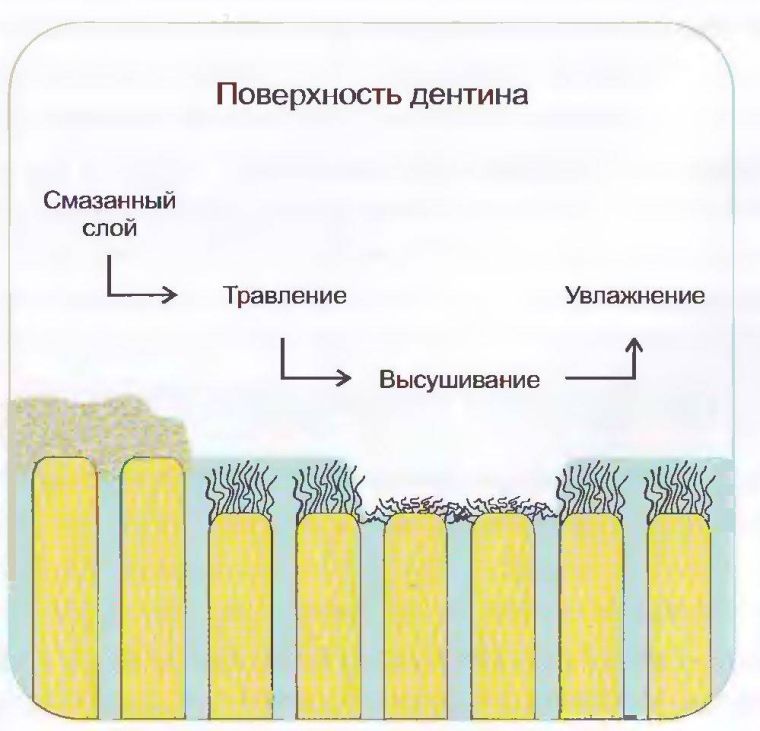 Укрепление лентина