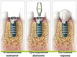 дентальная имплантация