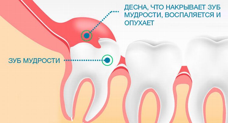 прорезание зуба мудрости