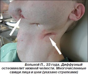 диффузный остеомиелит