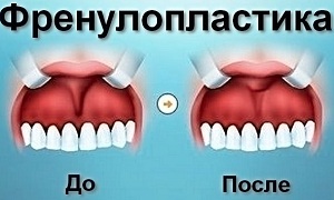 френулопластика