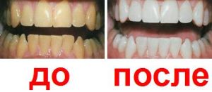 до и после отбеливания