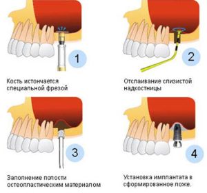 Наращивание костей челюсти