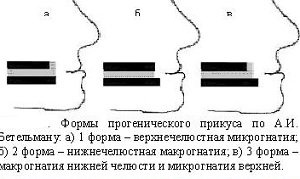 Формы прогенического прикуса