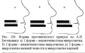 формы дистального прикуса