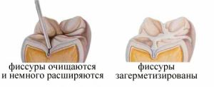 Герметизация фиссур