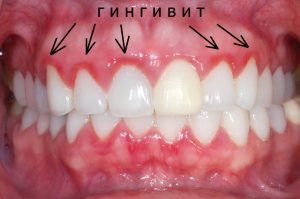 гингивит