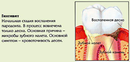 Схема гингивита