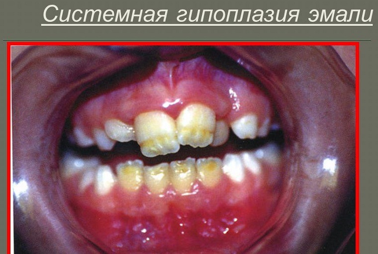 Системная гипоплазия эмали