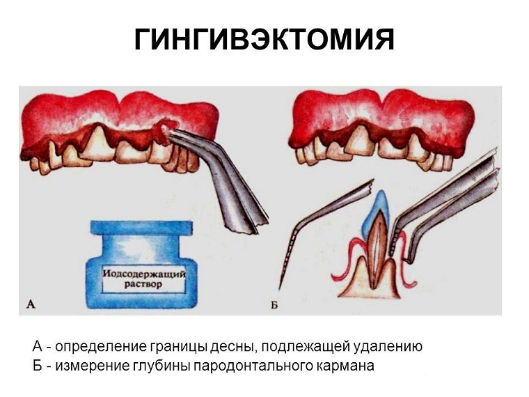 гингивэктомия