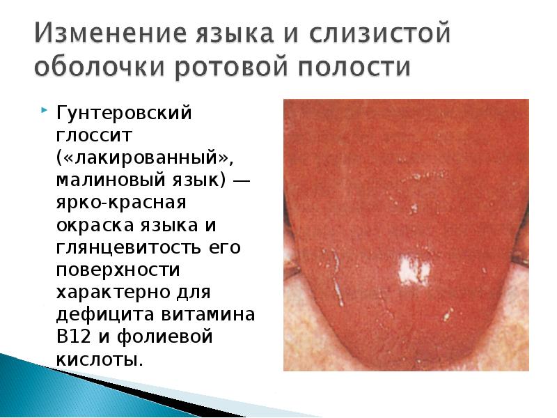 Гунтеровский глоссит