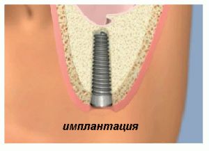 остеорегенерация