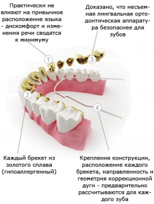 лингвальные брекеты инкогнито