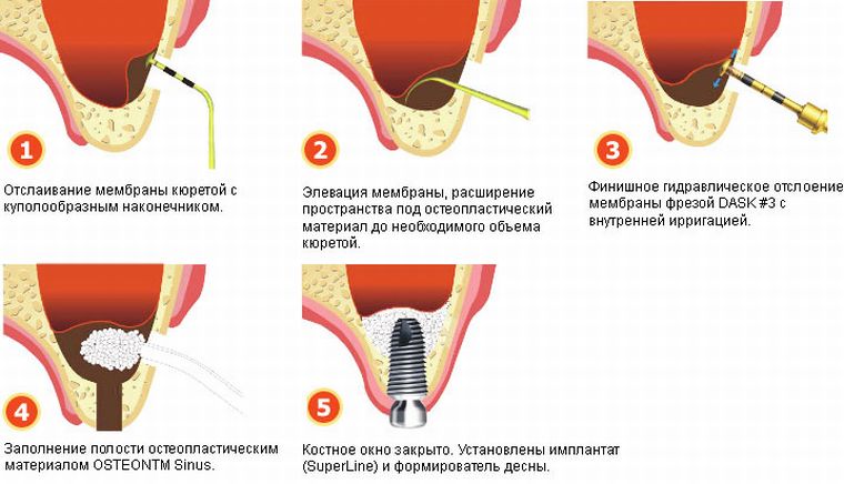 этапы остеопластики