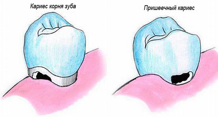 Пришеечный и кариес корня