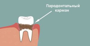 пародонтальный карман