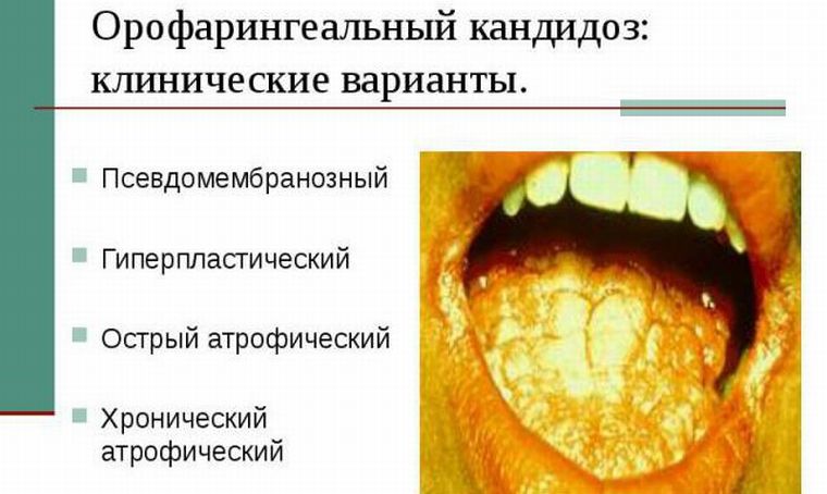 Виды молочницы во рту