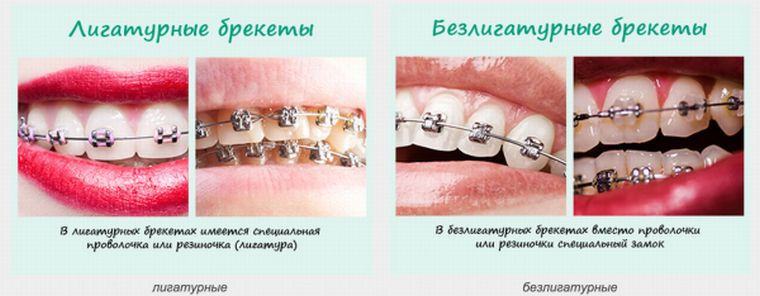 лигатурные и безлигатурные брекеты