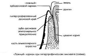 зубодесневой кармашек