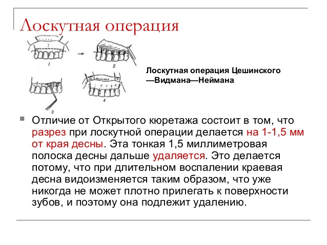 лоскутная операция