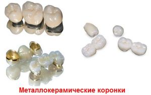 металлокерамика