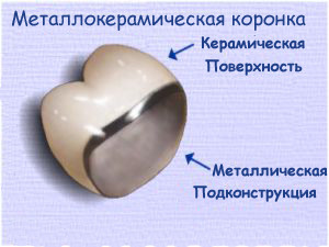 коронка из металокерамики