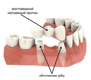 несъемный протез