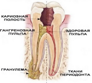 образование гранулемы