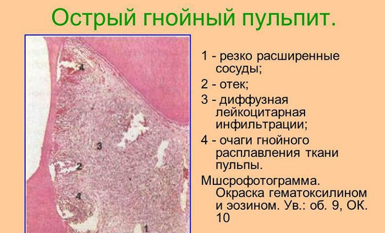 Острый гнойный пульпит