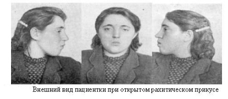 Рахитичный открытый прикус