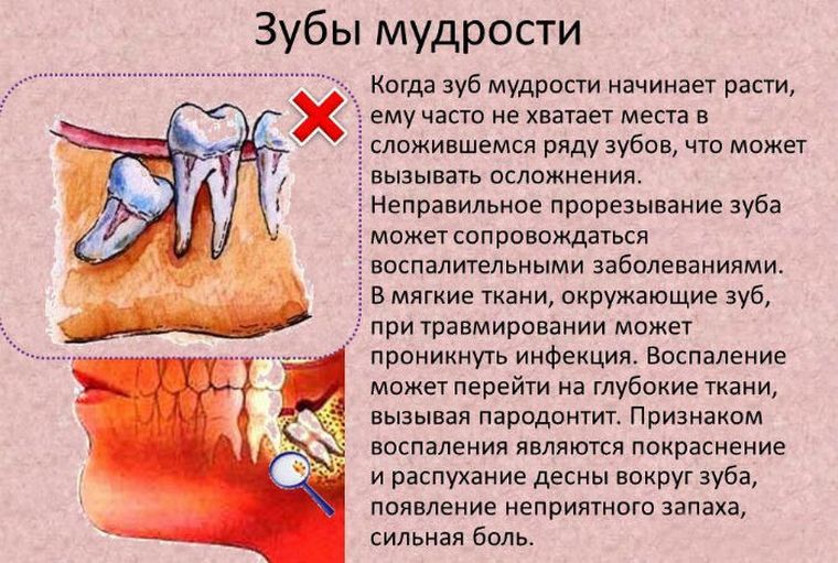 о зубах мудрости