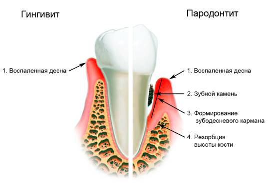 схема развития пародонтита